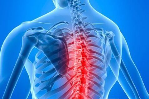 Osteocondrose torácica