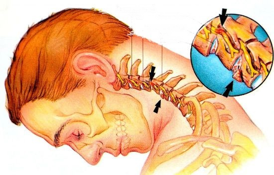 Osteocondrose cervical