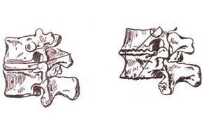 Estágios de desenvolvimento da osteocondrose torácica