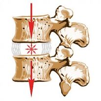 O dispositivo da coluna vertebral e as causas da osteocondrose