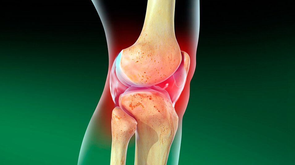 Osteoartrite da articulação do joelho