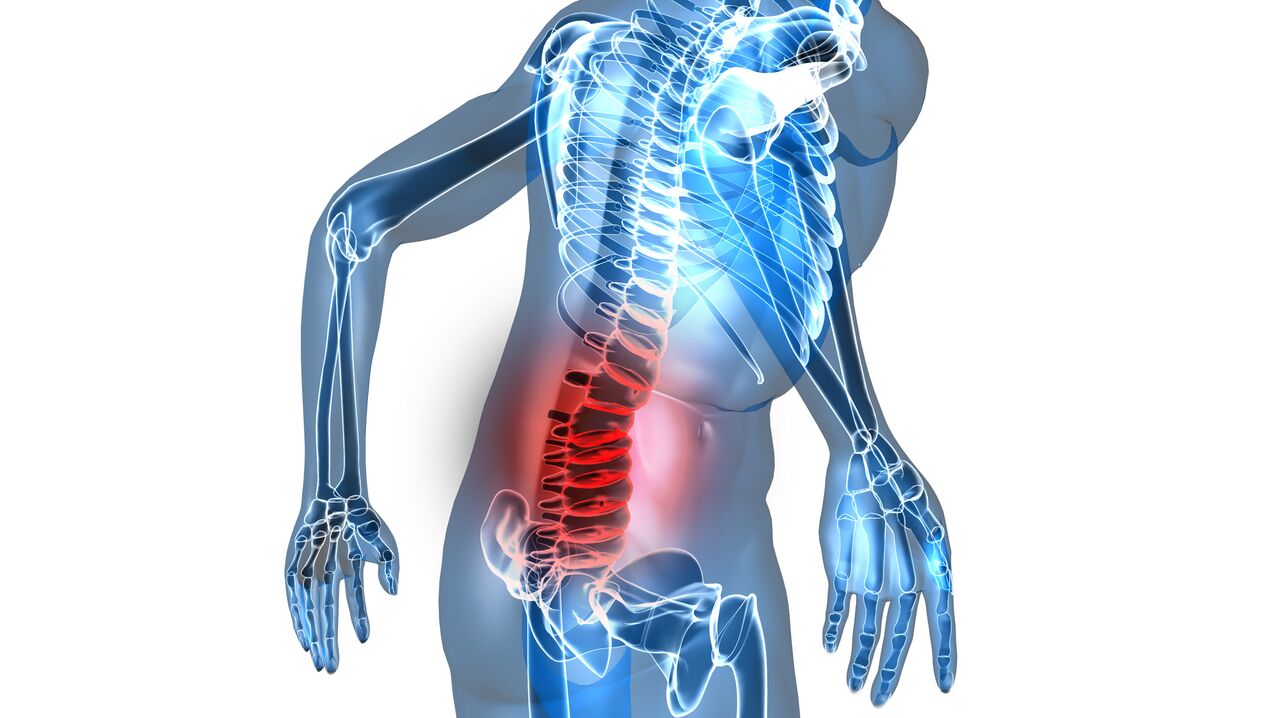 osteocondrose da coluna lombar